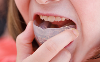 RWD-DentureMouthguard-Mouthguards