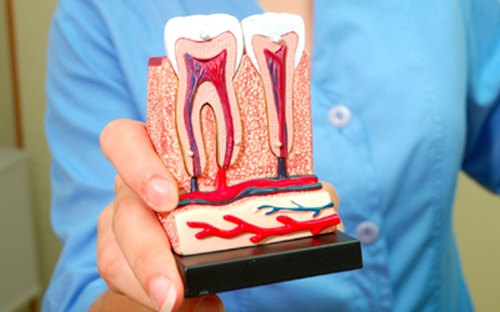 RWD-RootCanal-What-is-a-Root-Canal